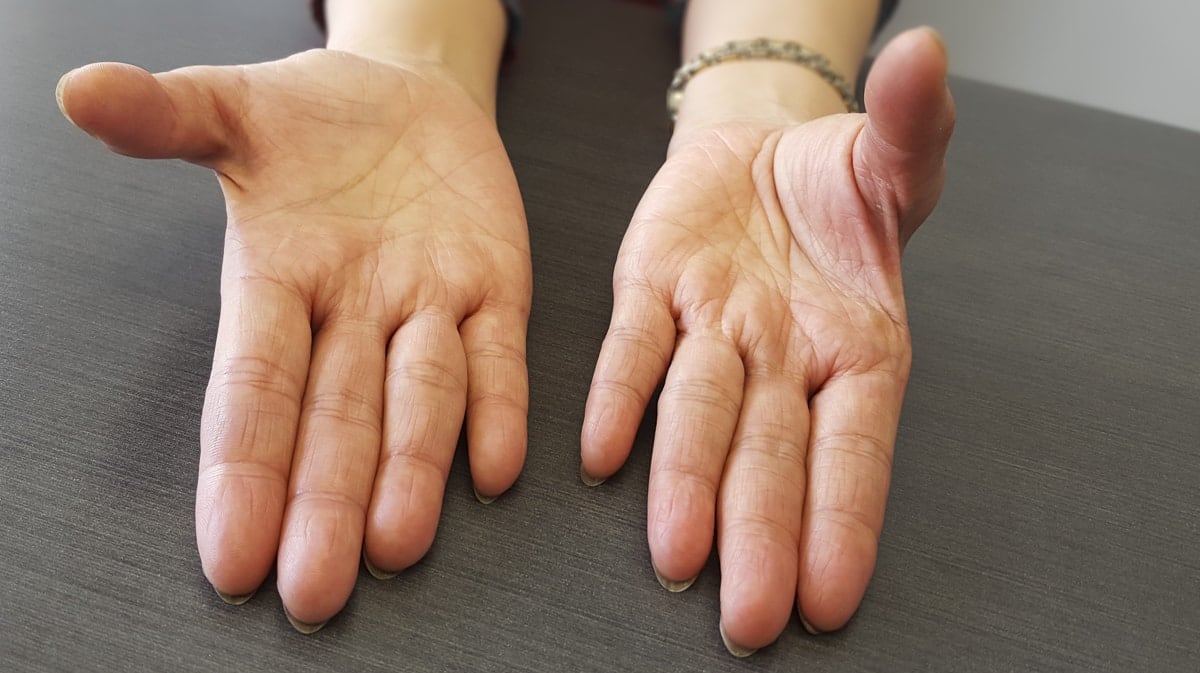 Muscle wasting in severe carpal tunnel